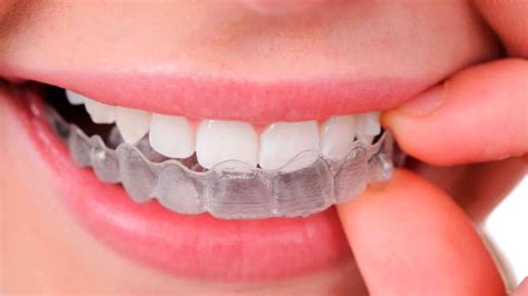 Braces, Clear Braces, Invisalign - Avon Dental Round Lake Beach