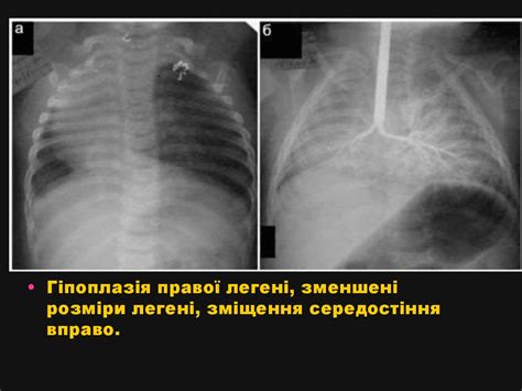 Вроджені вади розвитку легень, бронхів, трахеї - презентация онлайн