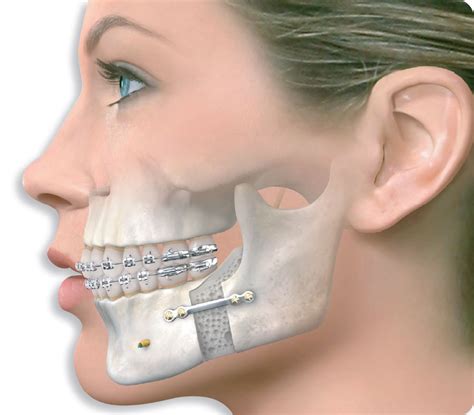 Jaw Surgery for Orthodontics (Maxilla and Mandible) - Kids Dental ...
