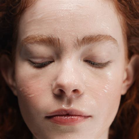 Xerosis Wikidoc Behçet's Disease Differential Diagnosis Wikidoc