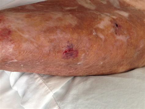 Skin Tear Healing | Beverly Hills Wound Care