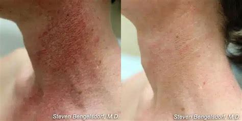 Photorejuvenation Before and Afters | Franklin Skin and Laser