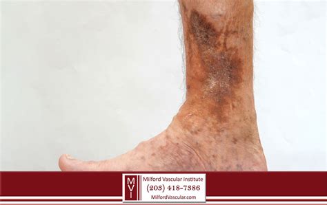 May-Thurner Syndrome is Iliac Vein Compression