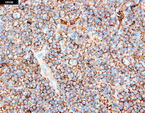 Pathology Outlines - Plasma cell leukemia