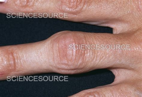 Rheumatoid arthritis finger joint | Stock Image - Science Source Images