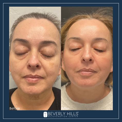 Chemical Peels – Beverly Hills Med Spa