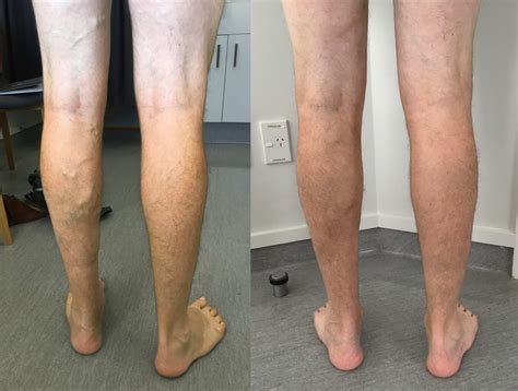 varicose vein treatment