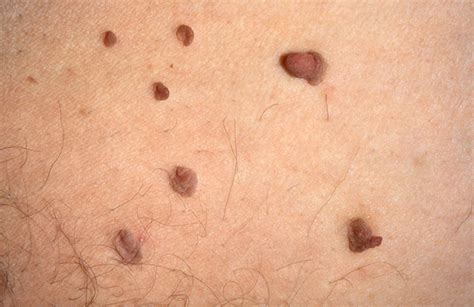 skin tags  symptoms  removal healthdirect