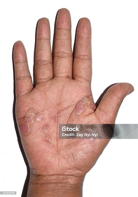 deskuamasi  kulit tangan  mengelupas  dermatitis telapak