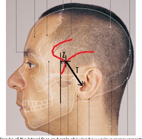 Groove For Middle Meningeal Vessels