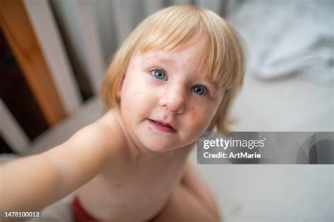 135 Chickenpox Rash Stock Photos, High-Res Pictures, and Images - Getty ...