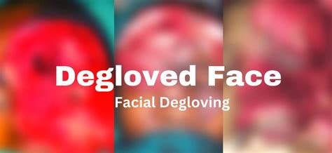 degloved faces  treatment  recovery