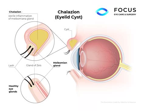 Chalazion Treatment Queens NYC Long Island NY