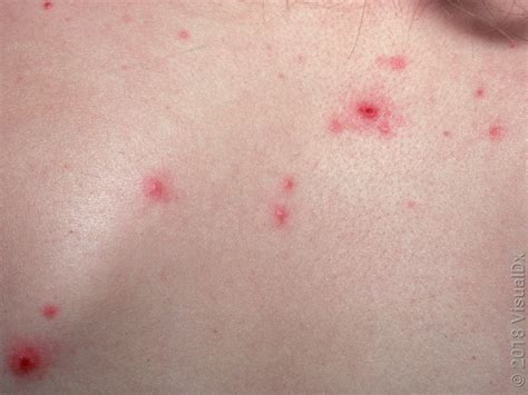 chickenpox   signs  images goodrx