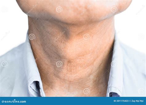 smooth diffuse thyroid swelling  southeast asian myanmar  burmese