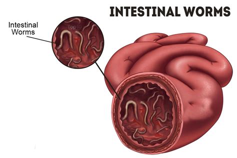 Intestinal Worms- Treatment By Herbalist Shah Nazir - Masala TV