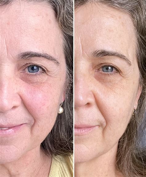 Vitacid Antes E Depois Rugas - Preenchedor de Rugas Bisyou: antes e depois!