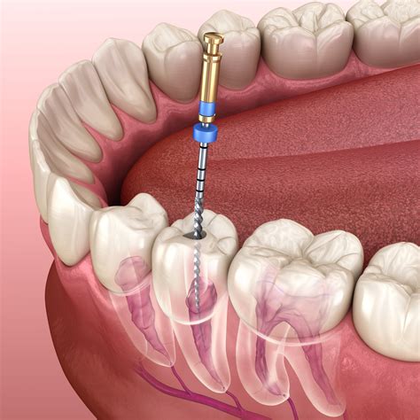 Root Canal Procedure: What to Expect and How It Can Save Your Tooth