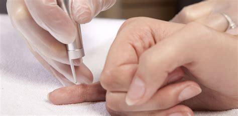 wart removal mclean potomac dermatology