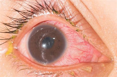 Iridocyclitis - All About Vision