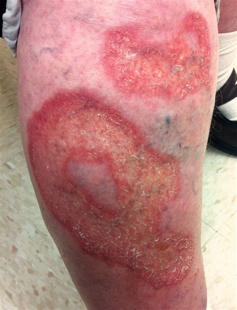 Necrobiosis Lipoidica - MEDizzy
