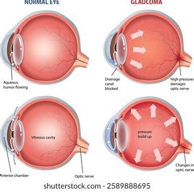 illustration glaucoma eye diagram stock vector royalty