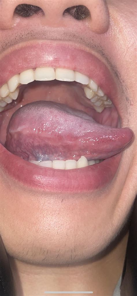 Oral Thrush? : r/Candida