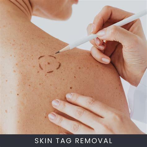Skin Tag Removal Skin Tag Removal | Beauty Travels 24
