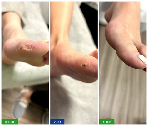 Plantar Wart Treatment - New Horizons Foot and Ankle Associates