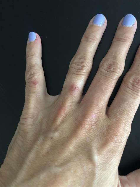 Gluten Sensitivity Reaction. Is anybody experiencing this reaction