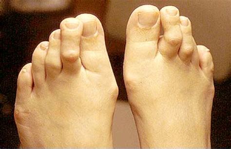 hammer toe toe job toe augmentation  toe shortening velvet zipse