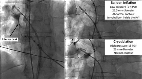 Cryoablation for atrial fibrillation - Heart Rhythm O2