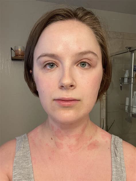 117 best r/urticaria images on Pholder | I cant anymore