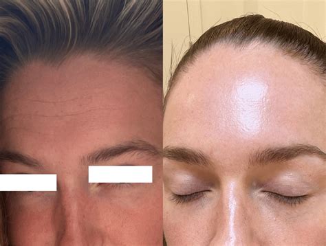 Before & After skincare results – LABAREAU
