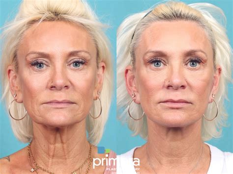 neck lift    pictures case  orlando winter park