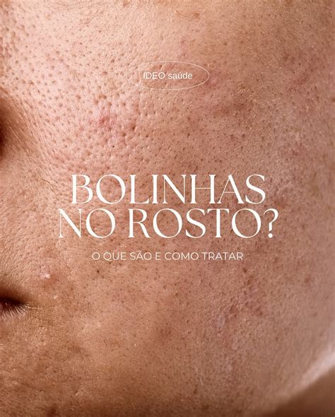 Rosto Cheio De Bolinha - Bolinhas no rosto? O que são e como tratar. - Ideo Saúde