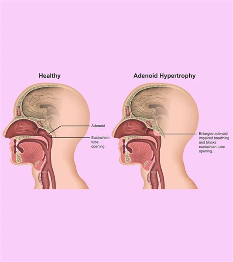 TB In Child: Types, Causes, Symptoms, Diagnosis, & Treatment