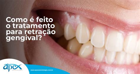 Remedio Para Gengiva Retraida - Como é feito o tratamento para retração gengival? - Ápex Odontologia