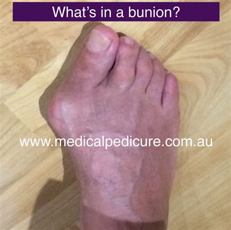 - Why Do I Suffer From Bunions? - Podiatry HQ