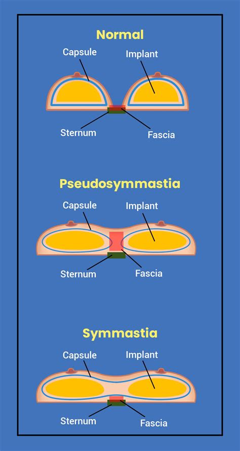 Remove if not allowed, but this (basic) diagram shows the phenomenon
