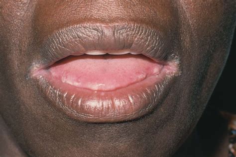 Angular Cheilitis: Symptoms and Treatment