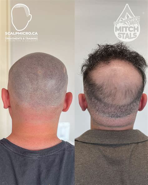 Scalp micro pigmentation will change the way men cut bald 40