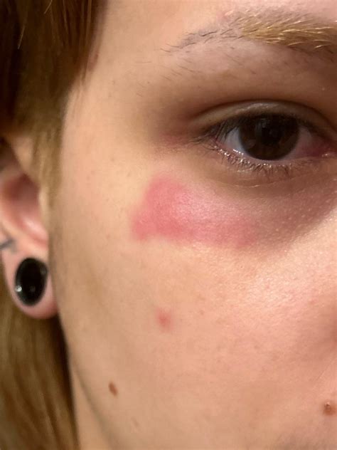 How To Stop Itchy Rash On Face at Angus Agar blog