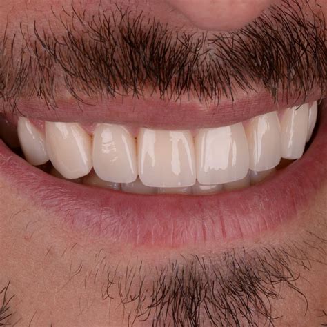 Carillas Dentales | Sergi Arranz Smile Studio Barcelona