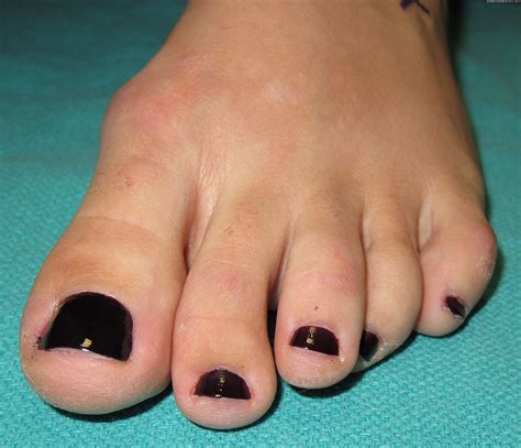 British Hammertoes are “Wonky Toes”! - City Footcare NYC | NYC's Top