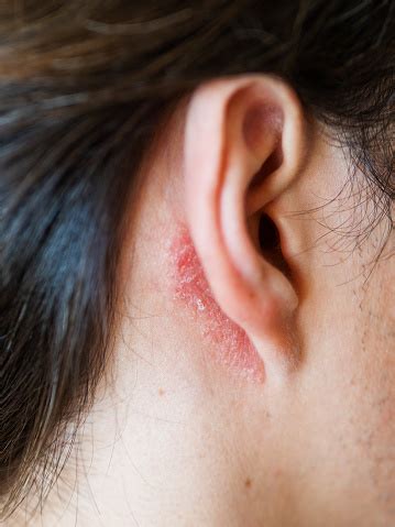 Fungo Atras Da Orelha - Foto de Irritação Na Pele Atrás Da Orelha Homem Com Pele Flaky Alergia ...