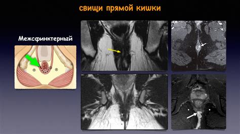 Визуализация прямой кишки и перианальной области