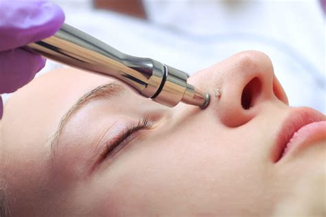 Microdermabrasion | NY | Hudson Dermatology