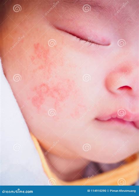 Newborn Baby with Allergy on Face Stock Photo - Image of food, baby