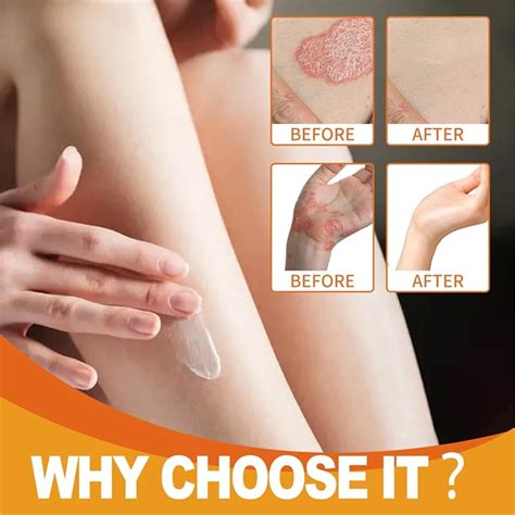 Todahof Bee Venom Psoriasis Treatment Cream Bee Venom Psoriasis